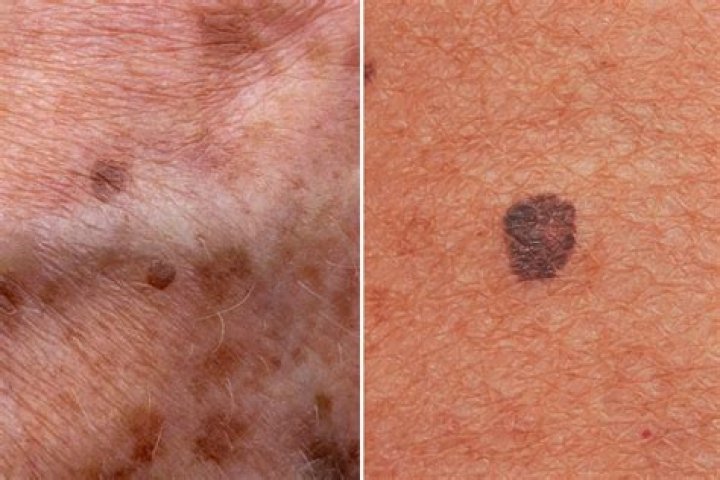 Can melanoma spread after being removed?
