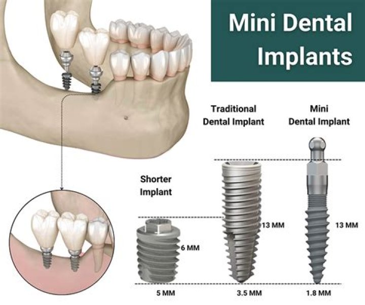 What dental category do implants fall under?